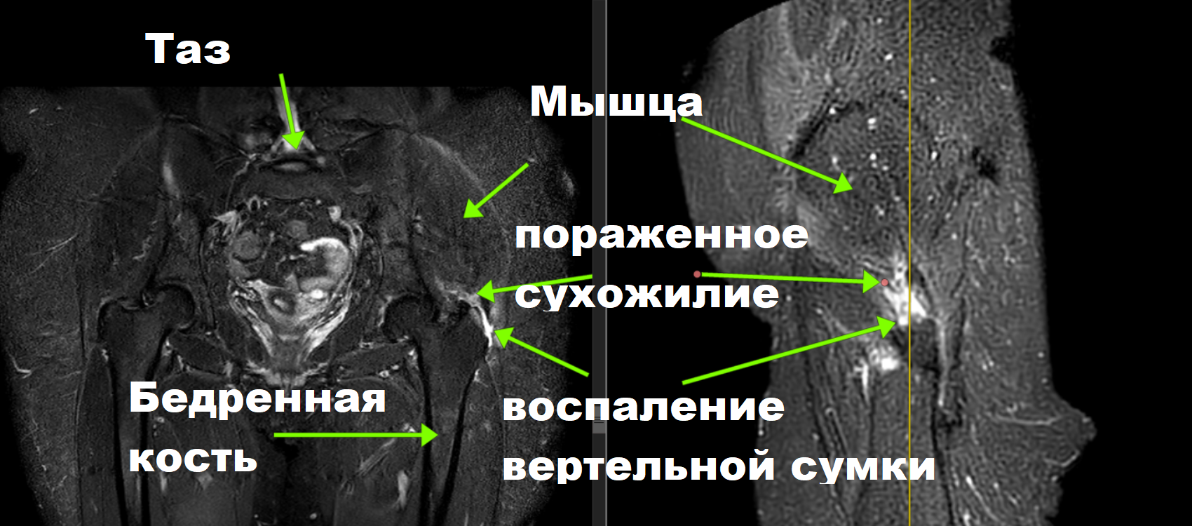 Перитрохантерит тазобедренного сустава. Анатомия тазобедренного сустава мрт. Трохантерит тазобедренного сустава мрт. Вертельная сумка тазобедренного сустава мрт. Сумки тазобедренного сустава мрт.